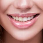 before and after whitening image
