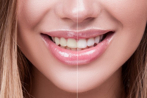 before and after whitening image